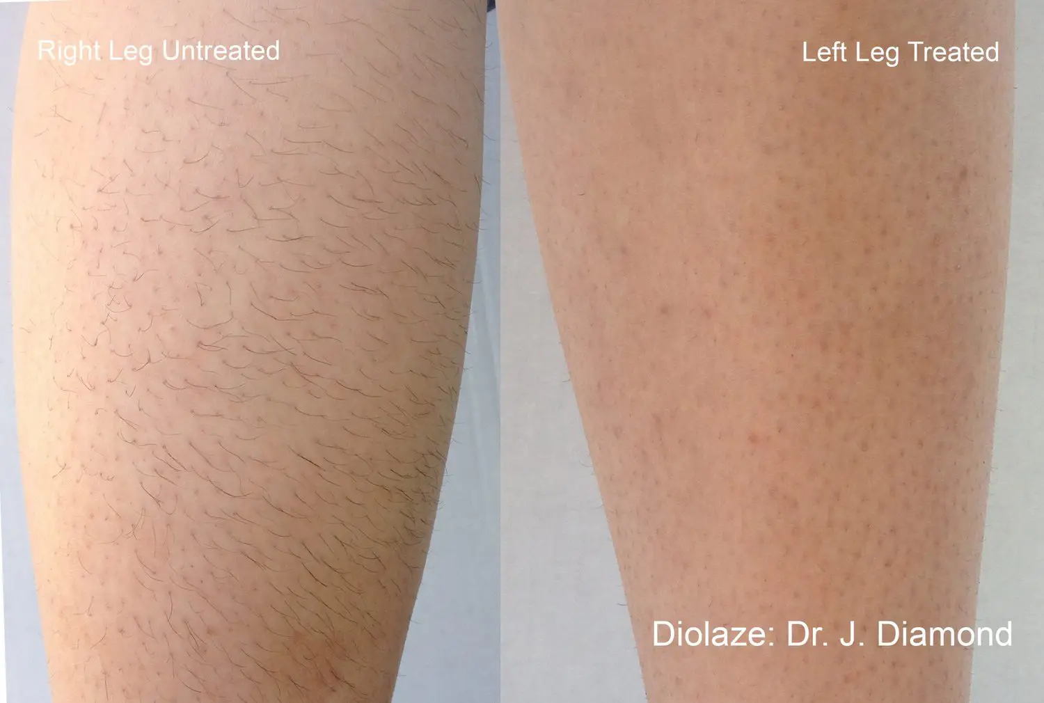 Laser Hair Removal in Costa Mesa CA Glo Bar Medspa