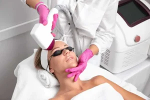 CoolPeel Laser Treatment in Costa Mesa, CA by GLO Bar MedSpa