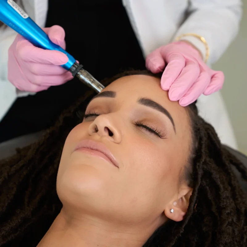 microneedling-in-costa-mesa-ca (1)